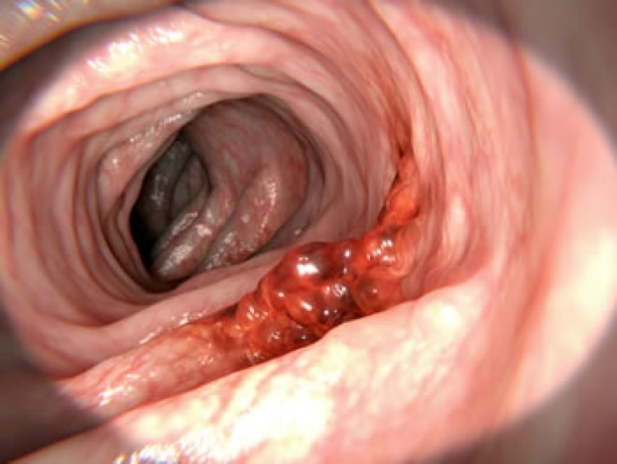 colon