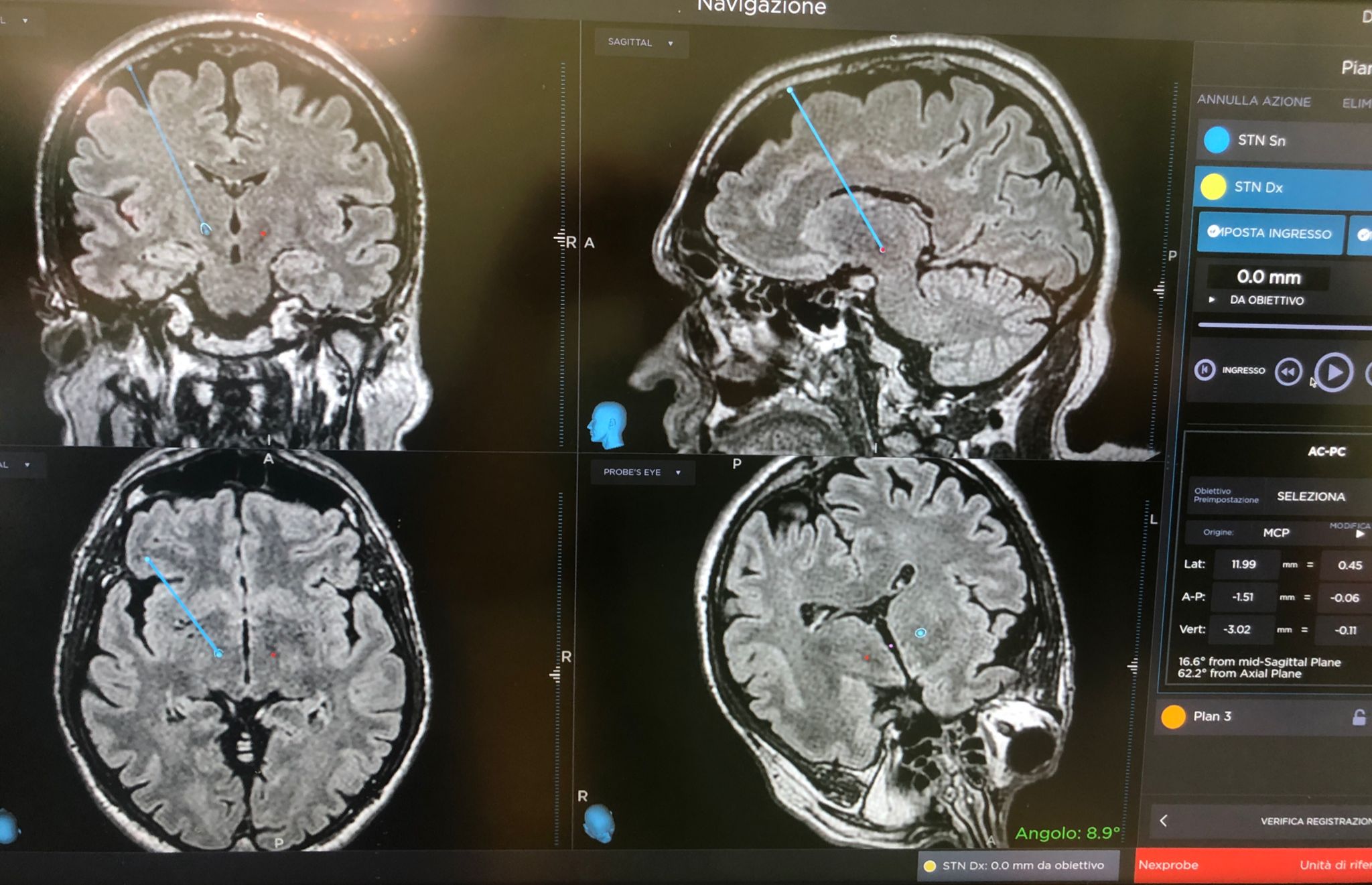 stimolazione cerebrale